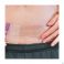 Lansinoh Patch Hydrogel Cesarienne (1) - Utilisation 1